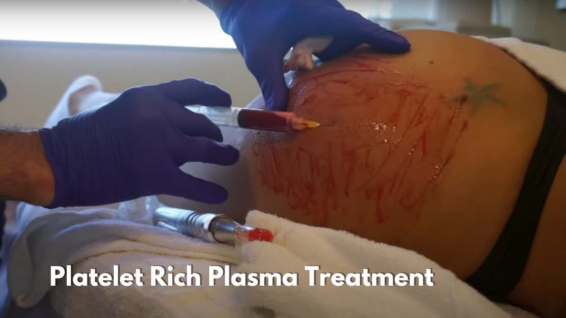 Platelet Rich Plasma (PRP) To Remove Stretch Marks
