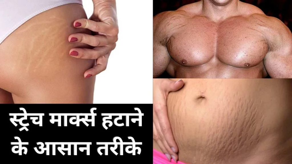 stretch marks kaise hataye